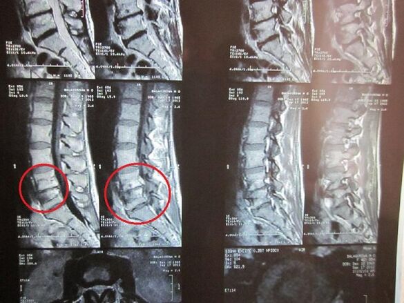 Dijagnoza cervikalne osteohondroze