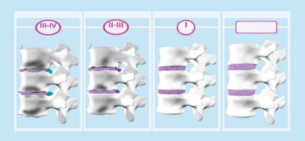 Faze cervikalne osteohondroze