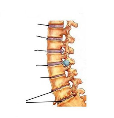 Kako se razvija osteohondroza