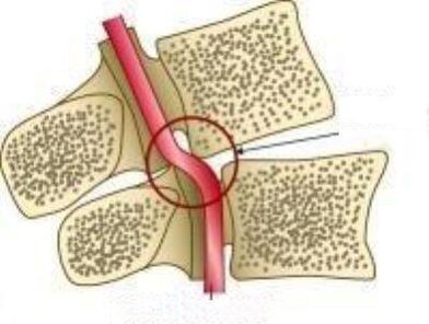 Sindrom vail arterije