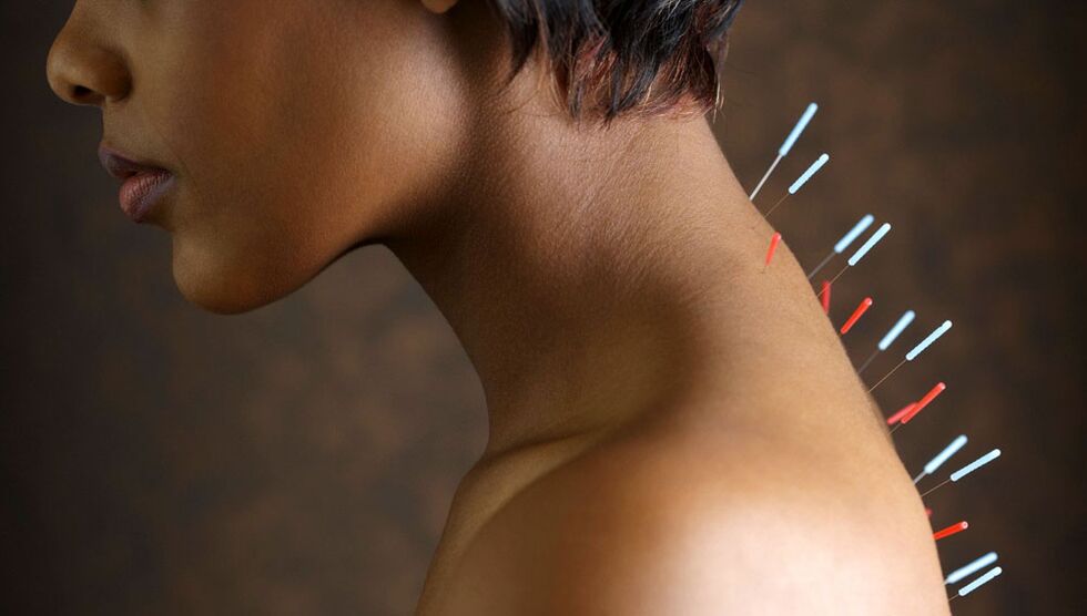 akupunktura s cervikalnom osteohondrozom