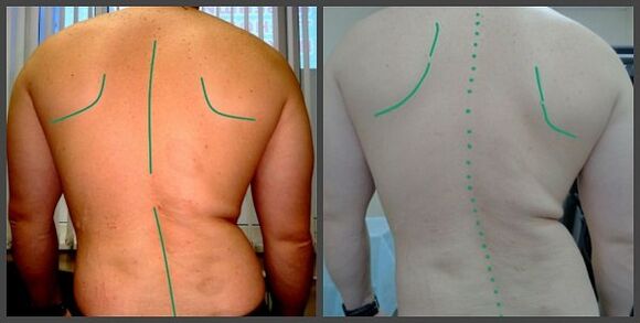 zakrivljenost kralježnice s osteohondrozom