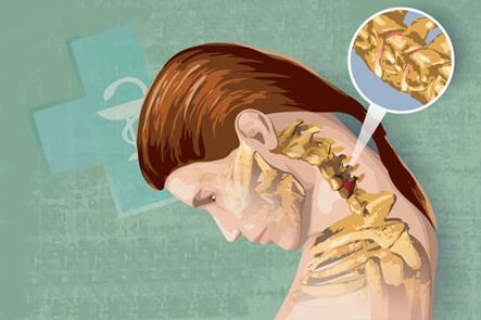 Refleksni simptomi osteohondroze